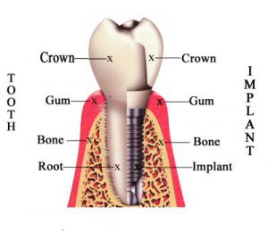 A dental implant diagram