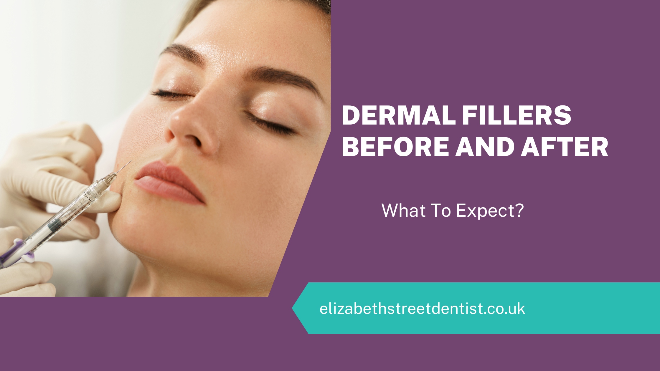 Dermal Fillers Before And After What To Expect? Elizabeth Street